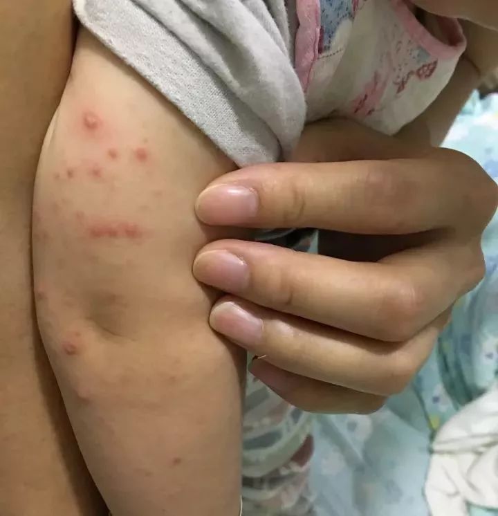 嘴里一个"小水泡",丢了孩子一条命,你提前预防了么?