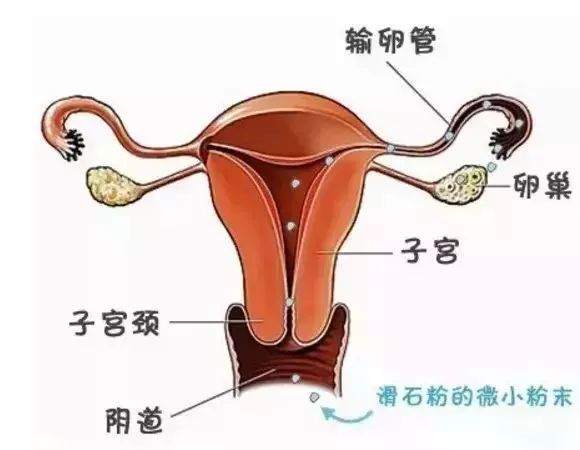 滑石粉的细小粉末可通过阴道,子宫,输卵管进入卵巢,刺激上皮细胞过度