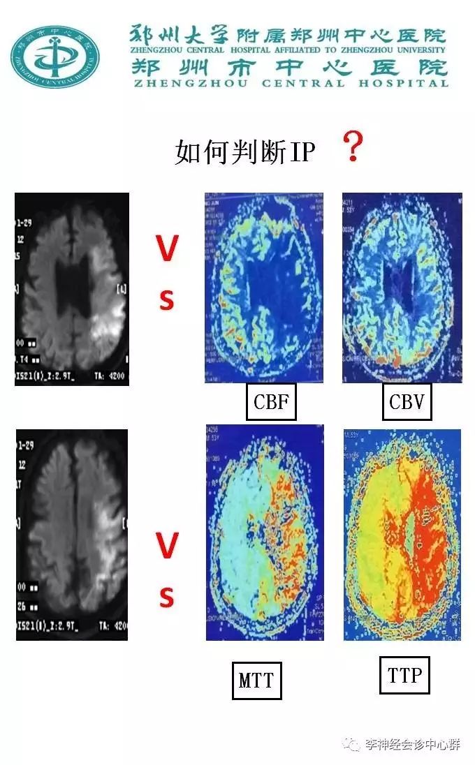 ppt+注释 | 脑灌注成像（dsc）的临床应用（1）--李润涛
