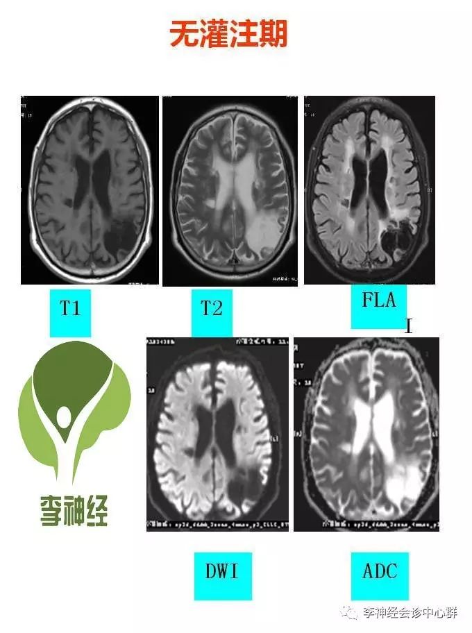 ppt+注释 | 脑灌注成像（dsc）的临床应用（1）--李润涛