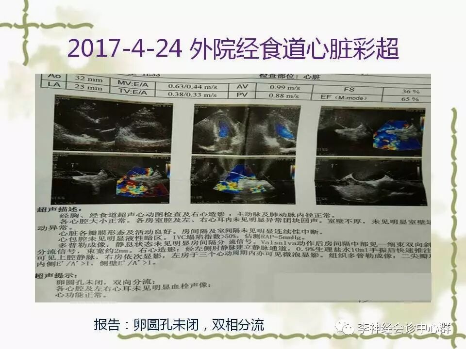 全群025 | 现实版卵圆孔未闭pfo封堵术的纠结 引发的学习与思考--曹