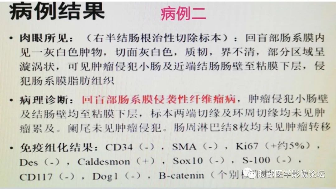 肠管丨回盲部肠系膜侵袭性纤维瘤病