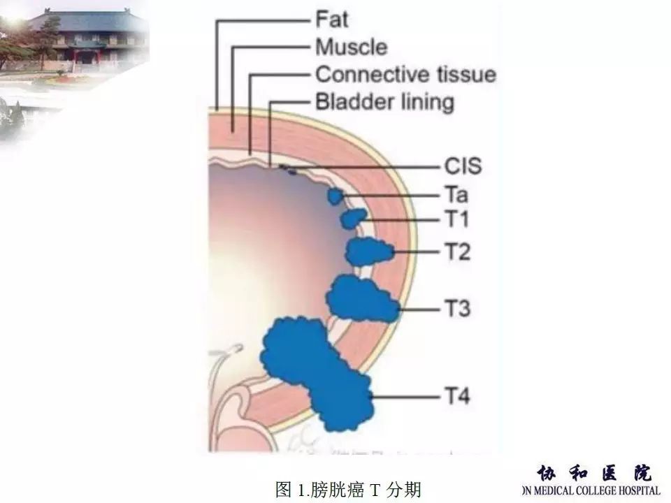 【课程回顾第17期上集】谢燚|腹腔镜膀胱癌根治术的解剖学特点及手术