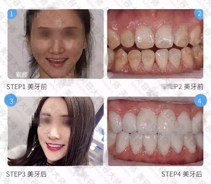 效果怎么样? 真人案例 ▼ 牙齿不齐可以选择牙贴面吗?