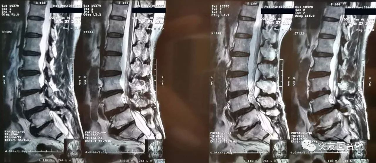 腰3椎体下缘许莫氏结节;考虑骶2-3椎