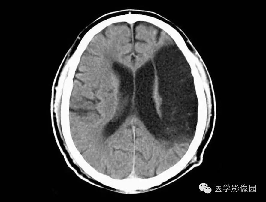 代表梗死灶内脑实质相对无损害区 额顶叶近中线两侧长条形低密度