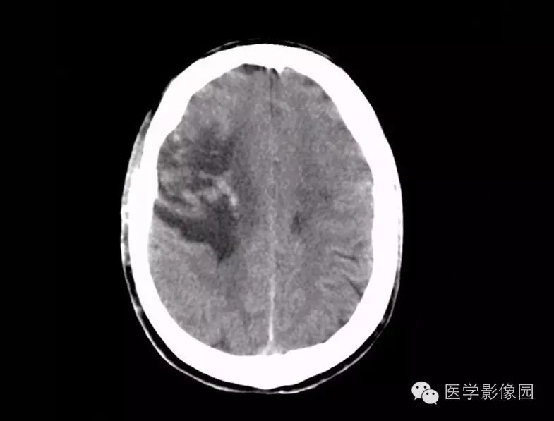 脑血管病变—脑梗死|精品连载《ct诊断与临床》(第二版)