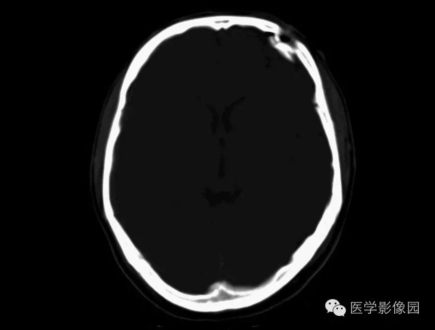 额窦,筛窦积液常见于前颅窝骨折,蝶窦积液可能为中颅窝骨折,乳突气房