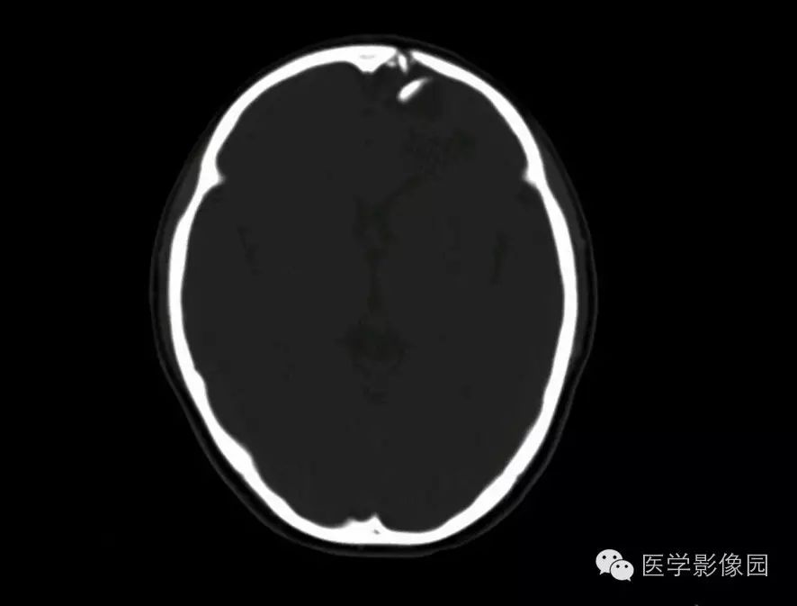 2)外伤后鼻窦或者乳突气房内可见气液平面或充满液体,这也是颅底骨折