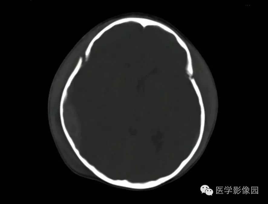 凹陷深度约8mm 骨窗像见右枕部线形骨折 骨窗像见患儿两侧冠状缝显示