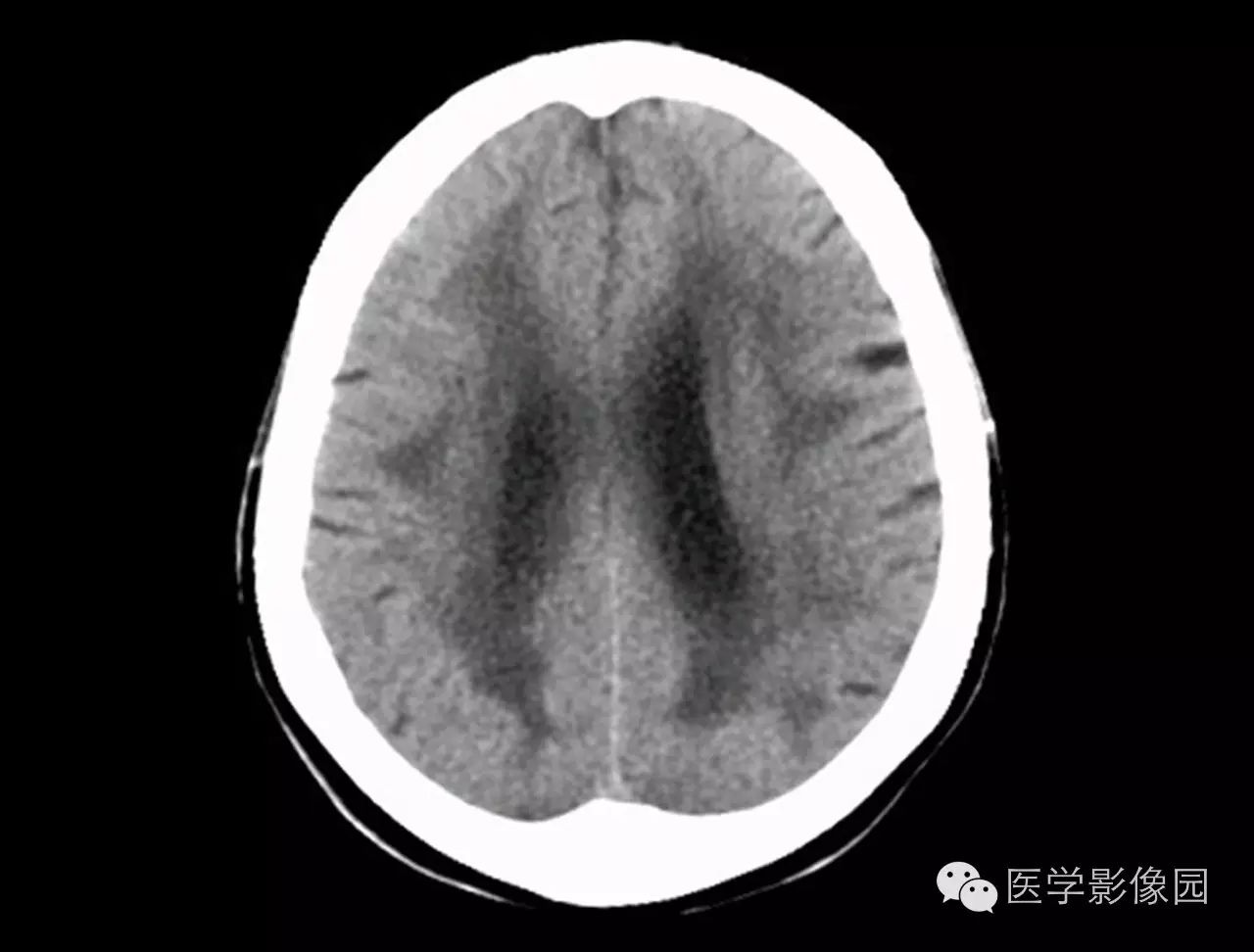 脑血管病变—皮质下动脉硬化性脑病|精品连载《ct诊断
