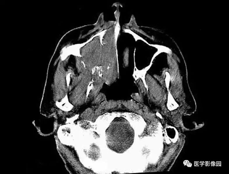 鼻,鼻窦,鼻咽和口咽—上颌窦癌|精品连载《ct诊断与临床(第二版)