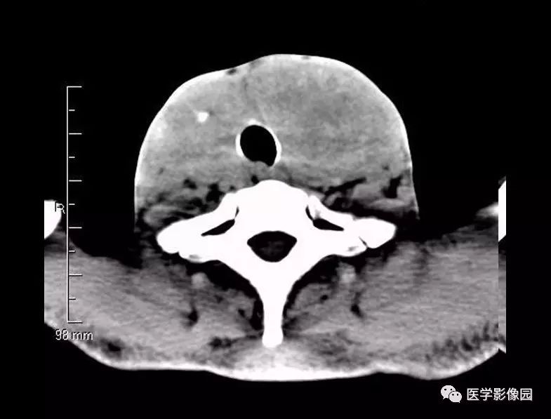 图3-7-1 单纯性甲状腺肿