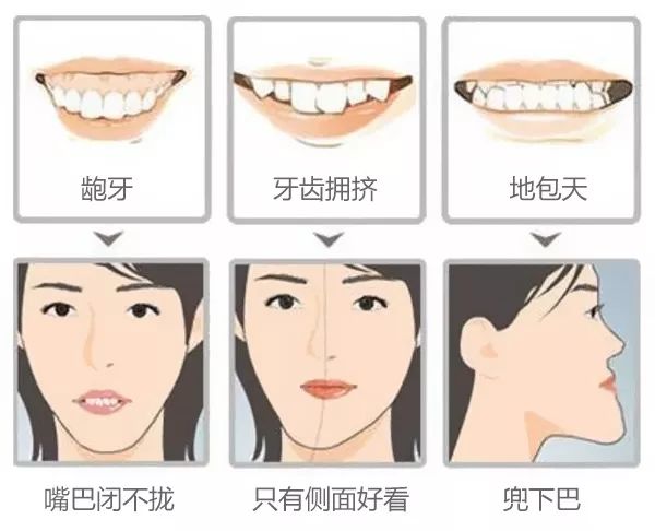 85%的人不懂:想要矫牙变美,关键是调整牙齿咬合!
