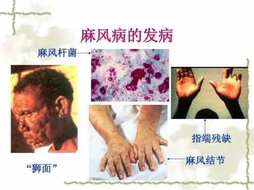 31世界防治麻风病日】麻风病很可怕?一文带你读懂它