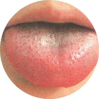 舌苔黄且干燥表示内有实热;舌体红且舌苔少或无苔,则阴虚内热