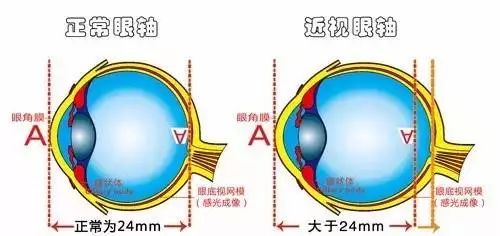 弱视是怎么形成的？它与近视有啥区别？