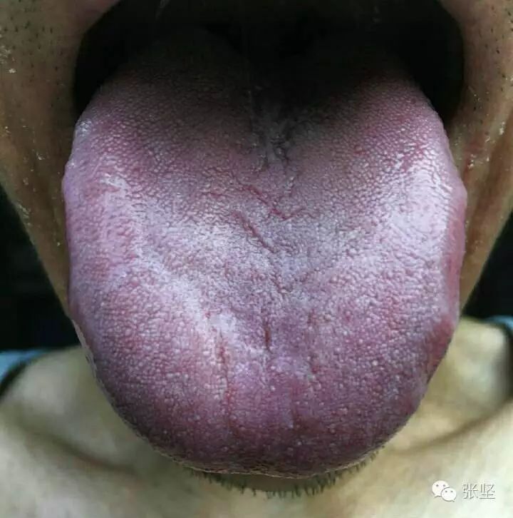 再看看一个典型的全舌紫的       再看看上图这个舌头除了