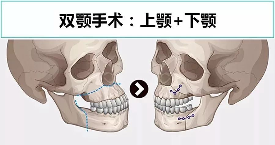 反颌,颜面不对称等下颌位置或功能不正常时,将上颚与下颚的骨骼截骨让