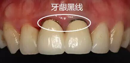 金属烤瓷牙真的有毒吗？