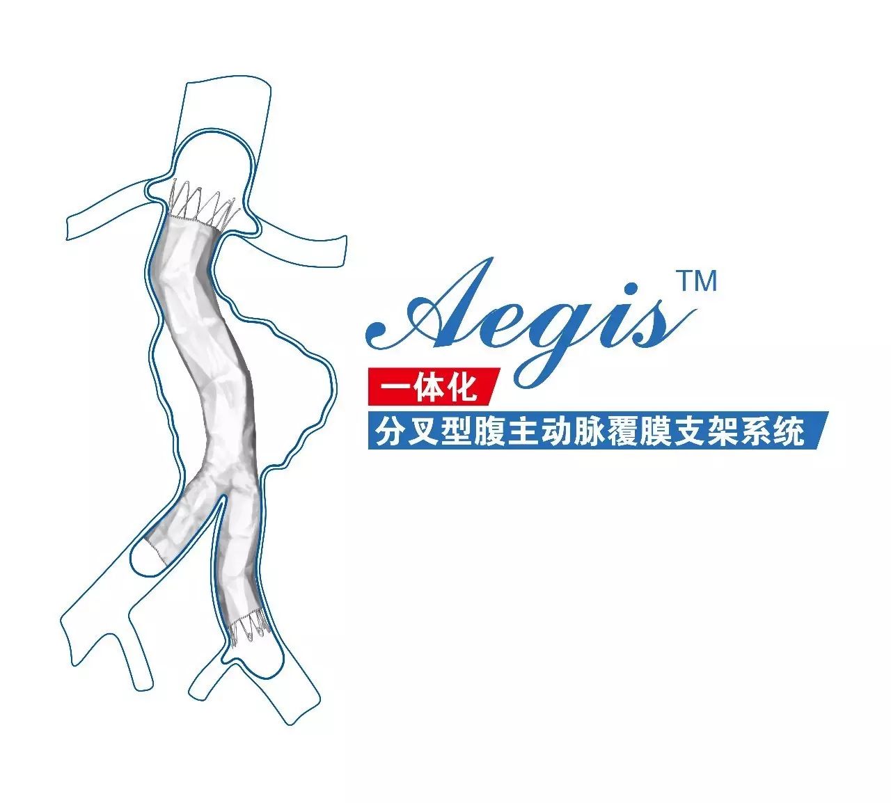 【病例分享】aegis分叉型大动脉复膜支架治疗腹主动脉假性动脉瘤