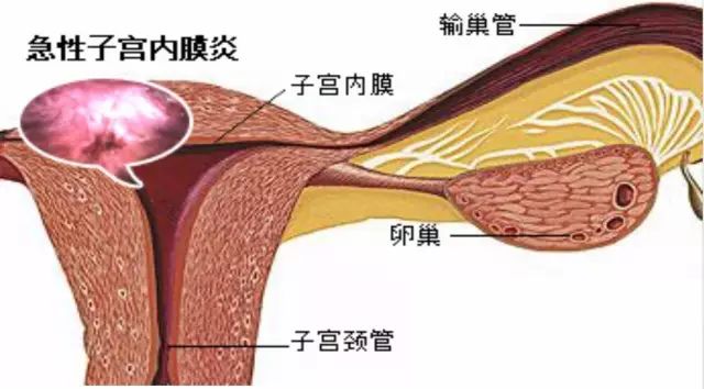 关于慢性子宫内膜炎