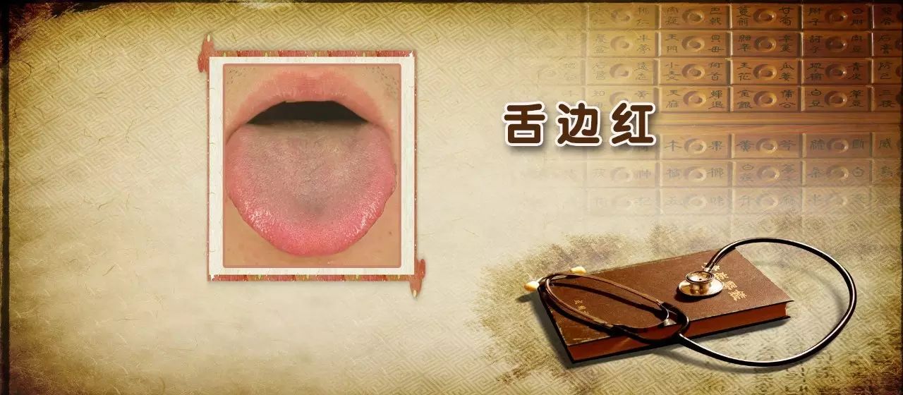 耳鸣等症状面部特征:全脸红,眼睛红,舌边红肝火上炎型高血压医学博士