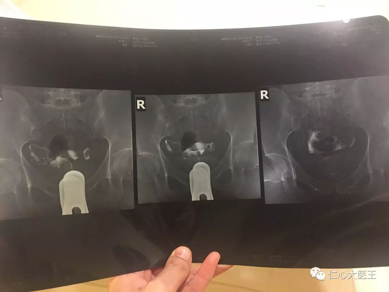 盆腔粘连输卵管不通,一度求子无门.7个月后竟然怀孕令我喜极而泣(附疾病治愈方法)-怀孕期