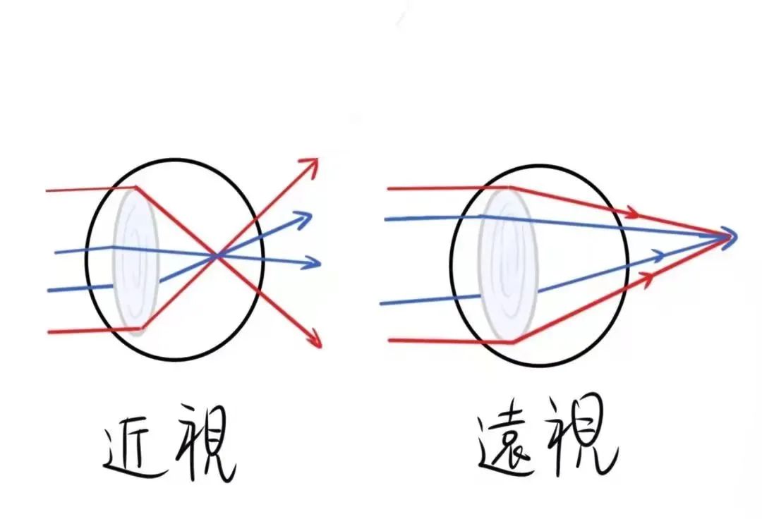 发现孩子有散光一定要配眼镜吗