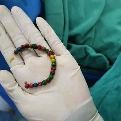 医学科普︱幼童被切去了两米小肠，罪魁祸首竟然是这个玩具！