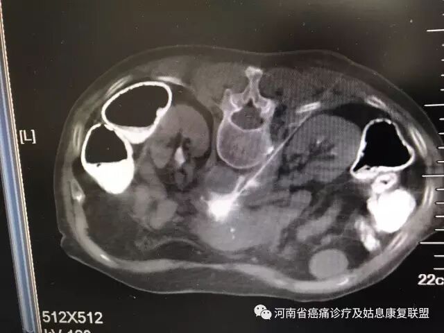 胰腺癌等腹部肿瘤引起的肚子痛，咋治？