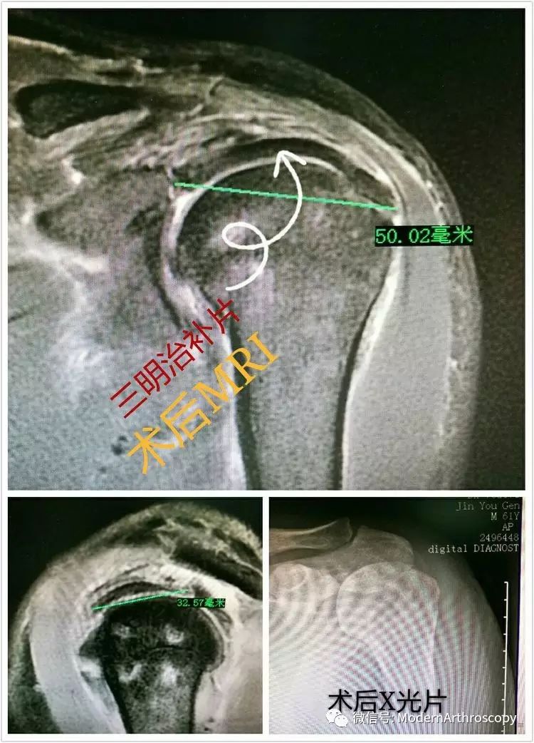 "三明治补片"上关节囊重建治疗巨大肩袖撕裂