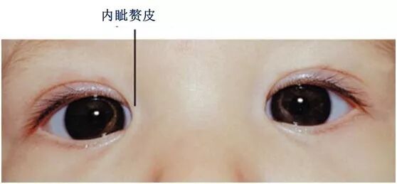 你的眼睛需要开眼角吗