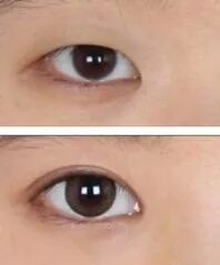 你的眼睛需要开眼角吗