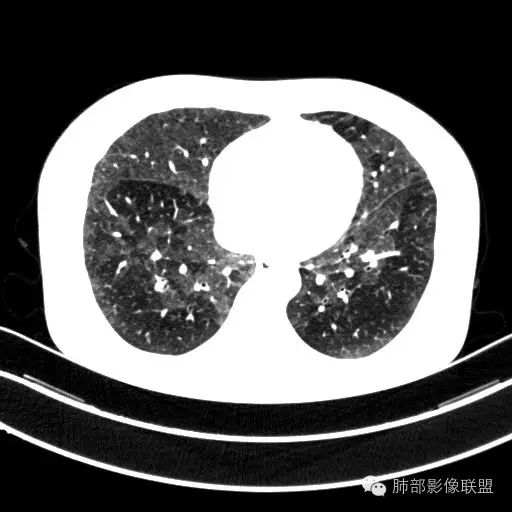 强调在标准肺窗上来看呢？小湖北 21:13大家看看病例二调过窗宽窗位的薄层小湖北 21:15大家看一