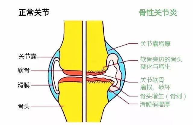 因此我们很多老年朋友会出现不同程度的关节疼痛,僵硬,甚至"交锁感"等