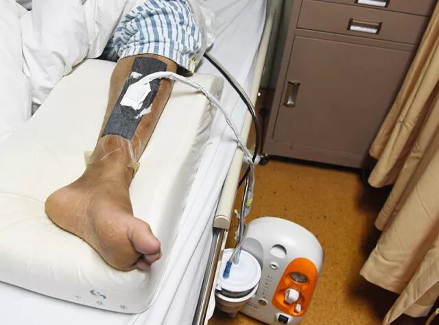 怎么促进vsd伤口愈合新技术 ｜ VSD，难愈性伤口不再难！_https://www.jmylbn.com_新闻资讯_第4张