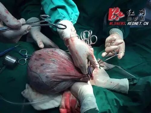 男子失踪12年在广州被同学发现,成断脚乞丐,家人将他接回浏阳;汨罗六旬老太肚大如怀孕,手术后发现竟是…丨早安湖南-怀孕期