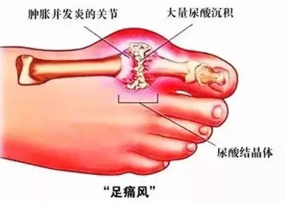 痛风到底有多可怕这篇文章说透了