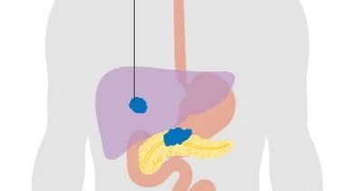 胰腺癌最新疗法:细胞疗法、肿瘤治疗电场、大麻素均上榜!