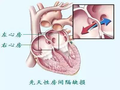 豫慈科普|房缺、室缺是什么？