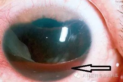 儿科医师查体时如何检查眼睛