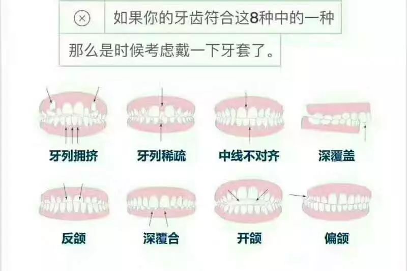 牙套的种类选择 普通金属矫治器