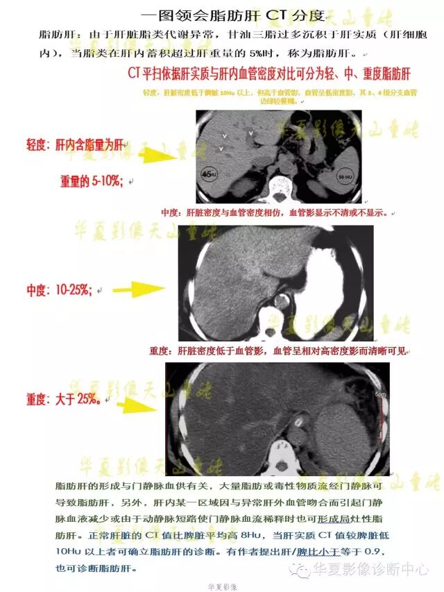 一图领会脂肪肝ct分度