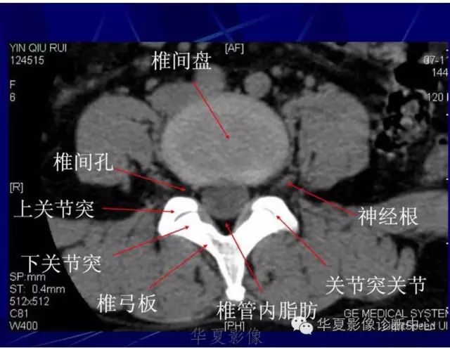 详细的腰椎解剖,椎间盘突出,膨出,看这里