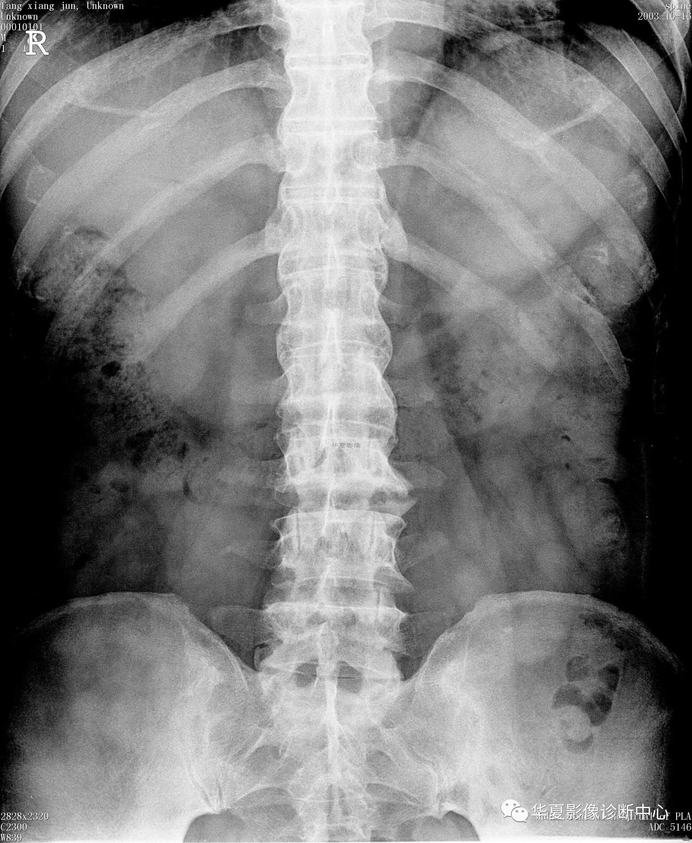 （风湿免疫科）“重男轻女”的疾病------强直性脊柱炎 健康科普 -沧州市人民医院