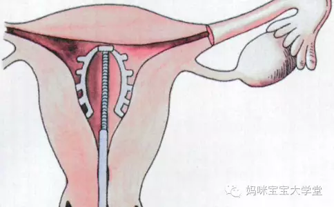 備孕二胎 女士們取環應注意什么