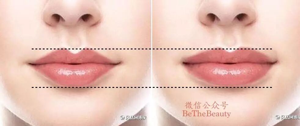 而除了上唇凹陷这一个变量, 嘴角对于整体嘴唇看起来的厚薄,也有很大