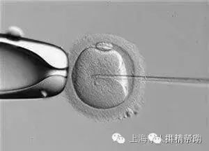 怀孕了!无精子症患者经过多学科诊疗模式治疗成功双胎妊娠!