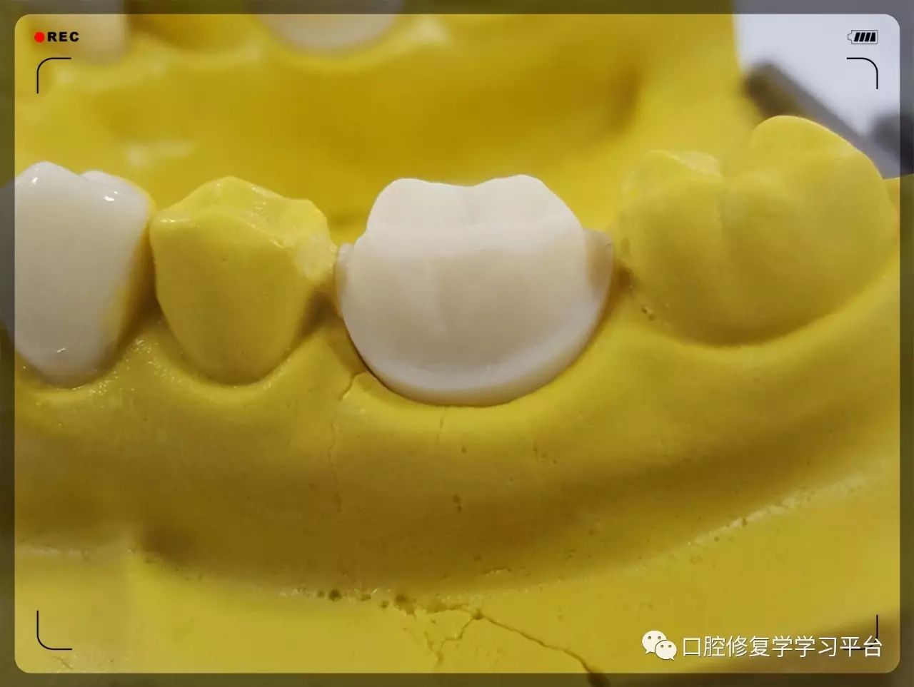 邻面要求: ①消除倒凹,与邻牙完全分离 ②与就位道一致 四,边缘修整